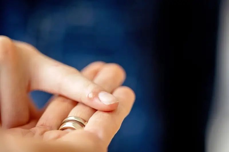 Od czego powstają kurzajki?